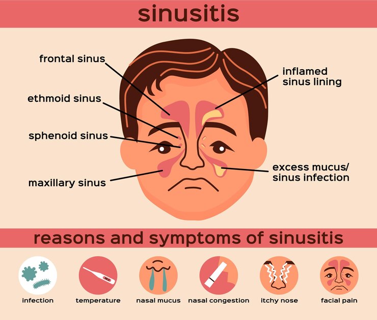 Sinusitis 