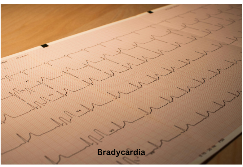 Bradycardia