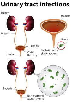 Urinary Tract Infections (UTI)